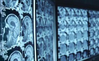 We Need More Neurologists: The Future Demand For Services